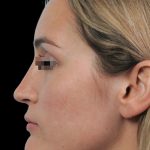 Thumbnail photo of the patient’s after the Rhinoplasty Patient 18
