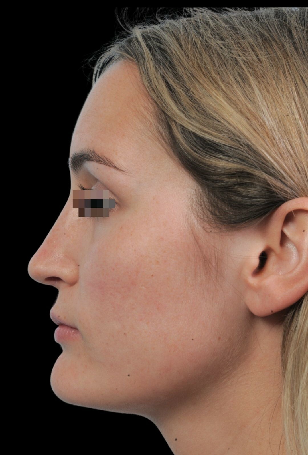 Photo of the patient’s face after the Rhinoplasty surgery. Patient 18 - Set 1