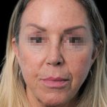 Thumbnail photo of the patient’s after the Rhinoplasty Patient 17