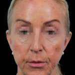 Thumbnail photo of the patient’s before the Rhinoplasty Patient 17