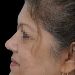 Thumbnail photo of the patient’s after the Rhinoplasty Patient 11