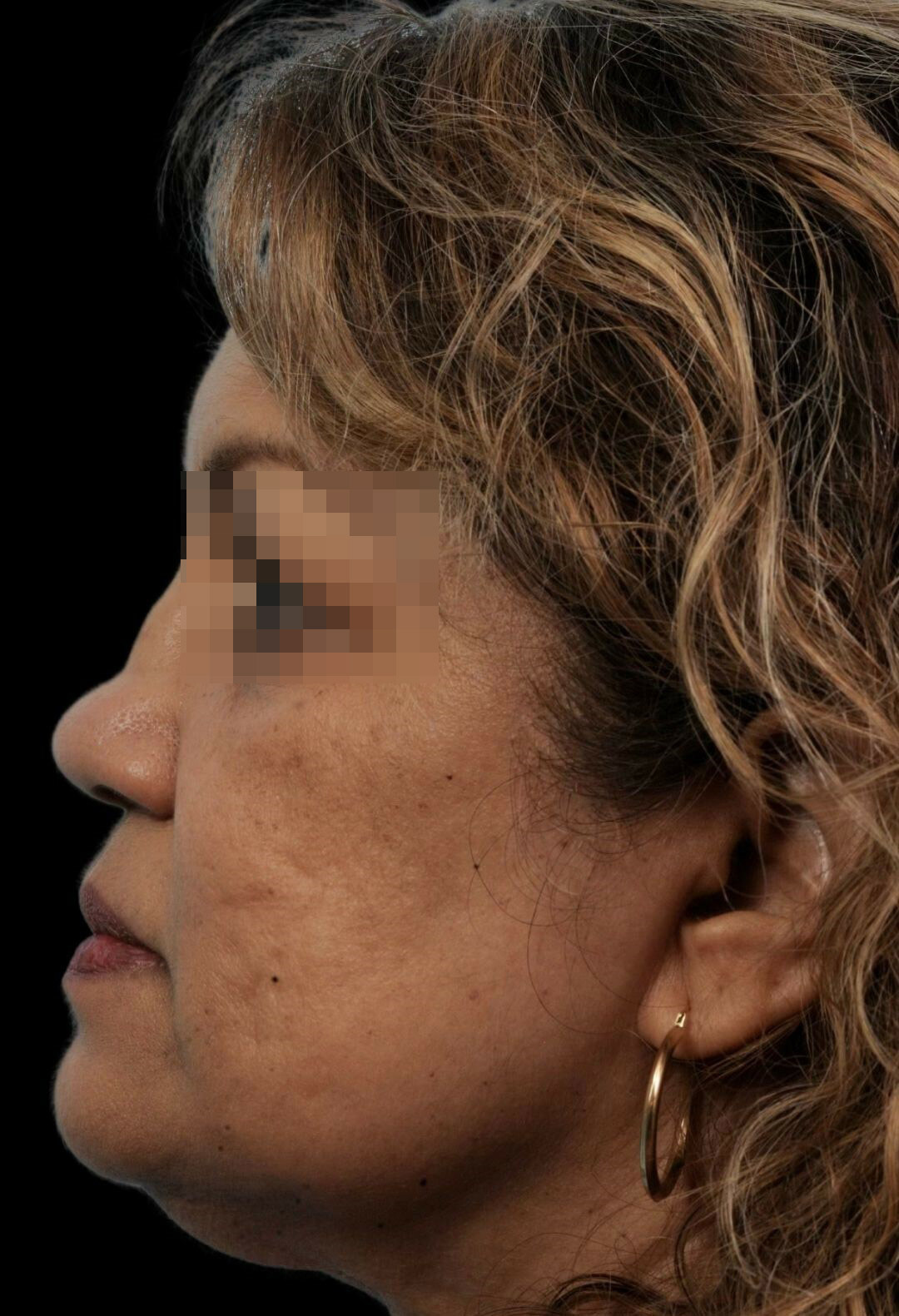 Photo of the patient’s before the Rhinoplasty Patient 11