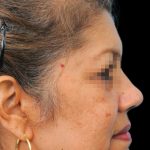 Thumbnail photo of the patient’s after the Rhinoplasty Patient 11