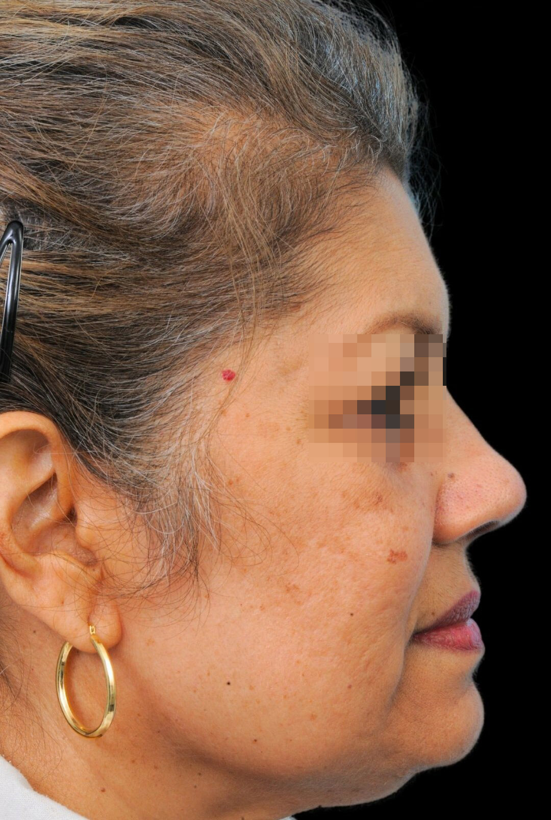 Photo of the patient’s after the Rhinoplasty Patient 11
