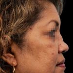 Thumbnail photo of the patient’s before the Rhinoplasty Patient 11