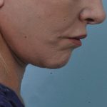 Thumbnail photo of the patient’s after the Neck Lift Patient 1