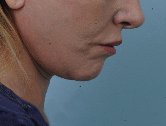 Photo of the patient’s after the Neck Lift Patient 1
