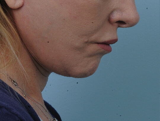 Photo of the patient’s face after the Necklift surgery - Set 1 - Patient 1
