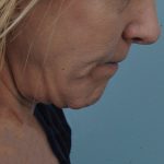 Thumbnail photo of the patient’s before the Neck Lift Patient 1