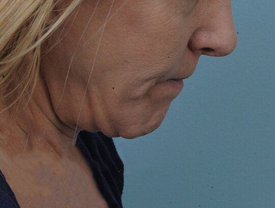 Photo of the patient’s before the Neck Lift Patient 1