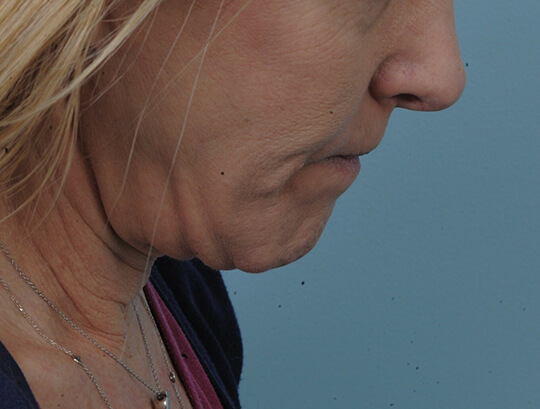 Photo of the patient’s face before the Necklift surgery - Set 1 - Patient 1
