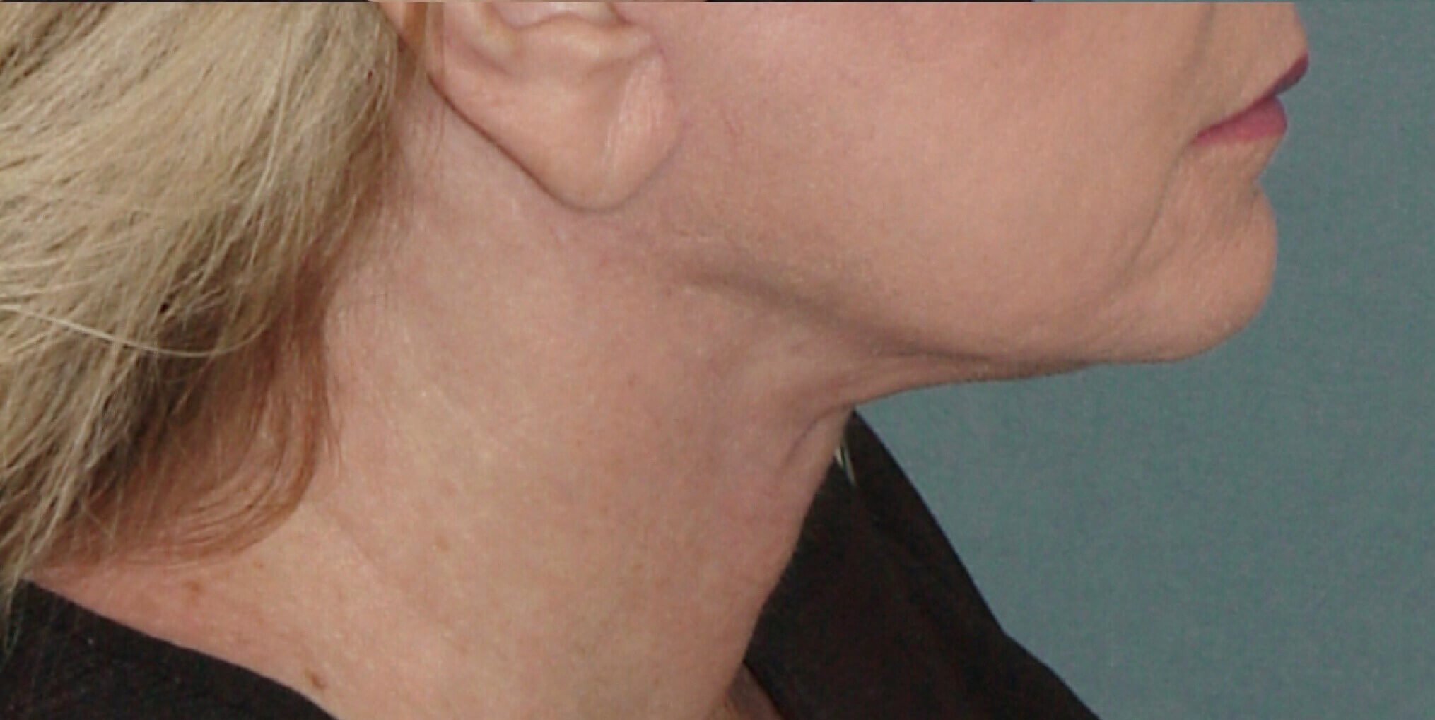 Photo of the patient’s face after the Necklift surgery - Set 1 - Patient 2