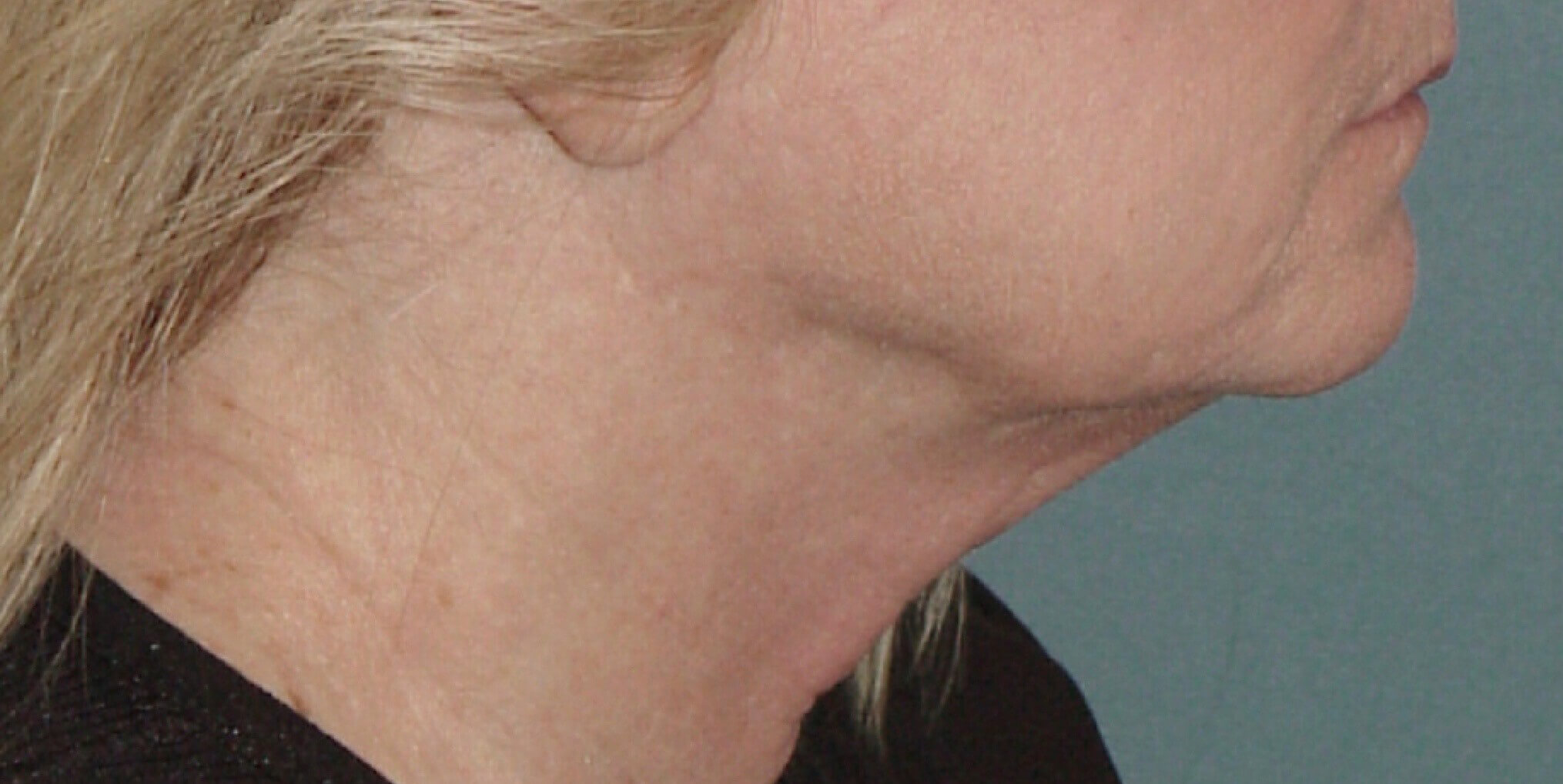 Photo of the patient’s face before the Necklift surgery - Set 1 - Patient 2