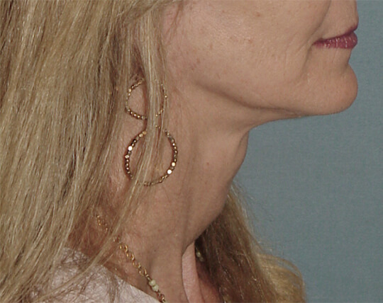 Photo of the patient’s face after the Necklift surgery - Set 1 - Patient 3