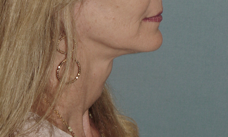 Photo of the patient’s after the Neck Lift Patient 3