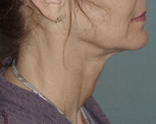 Photo of the patient’s face before the Necklift surgery - Set 1 - Patient 3
