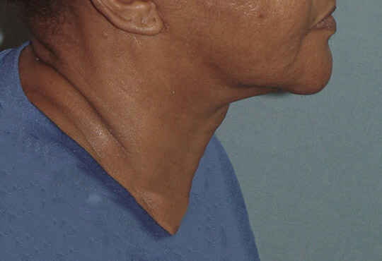 Photo of the patient’s after the Neck Lift Patient 4