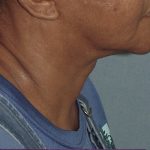 Photo of the patient’s face after the Necklift surgery - Set 1 - Patient 4