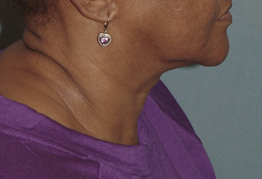 Photo of the patient’s face before the Necklift surgery - Set 1 - Patient 4