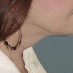 Thumbnail photo of the patient’s after the Neck Lift Patient 5