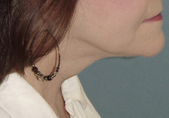 Photo of the patient’s face after the Necklift surgery - Set 1 - Patient 5