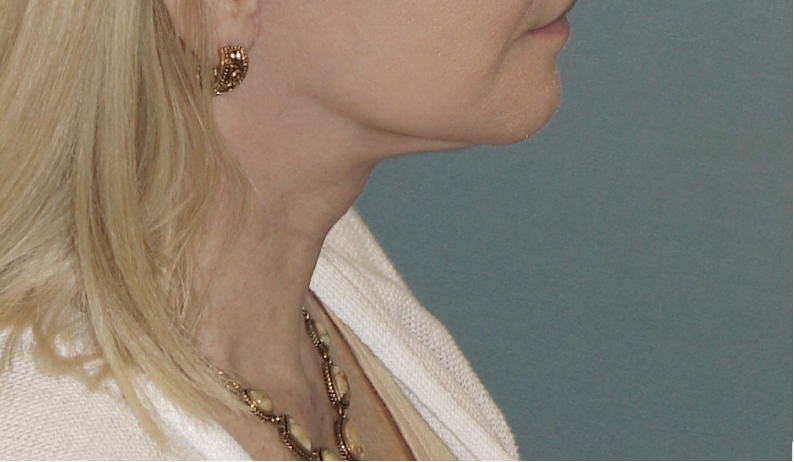 Photo of the patient’s after the Neck Lift Patient 6