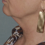 Thumbnail photo of the patient’s before the Neck Lift Patient 7