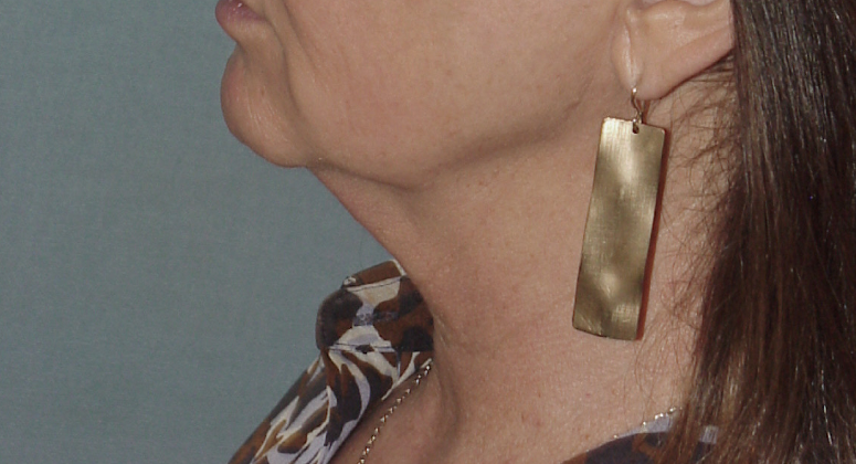 Photo of the patient’s before the Neck Lift Patient 7