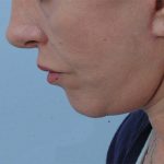 Thumbnail photo of the patient’s after the Neck Lift Patient 1