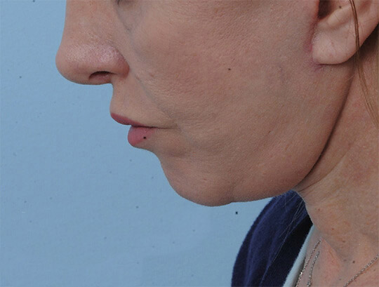 Photo of the patient’s after the Neck Lift Patient 1