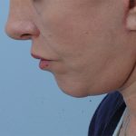 Photo of the patient’s face after the Necklift surgery - Set 1 - Patient 8