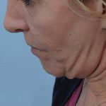 Thumbnail photo of the patient’s before the Neck Lift Patient 1