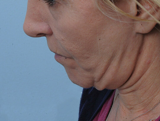 Photo of the patient’s before the Neck Lift Patient 1