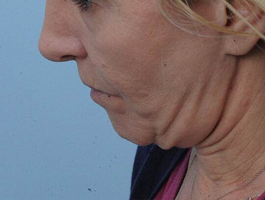 Photo of the patient’s face before the Necklift surgery - Set 1 - Patient 8