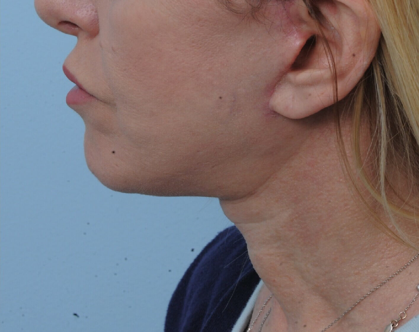 Photo of the patient’s face after the Necklift surgery - Set 1 - Patient 9