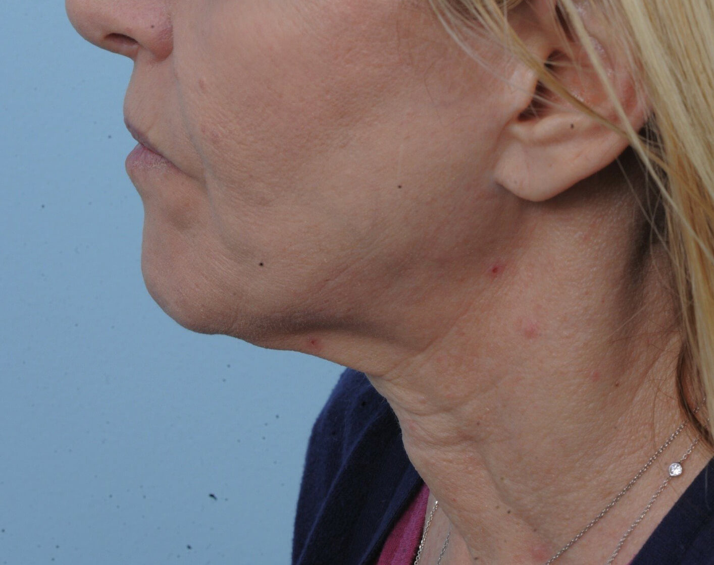 Photo of the patient’s face before the Necklift surgery - Set 1 - Patient 9