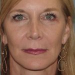 Thumbnail photo of the patient’s after the Facelift Patient 1