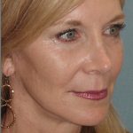 Thumbnail photo of the patient’s after the Facelift Patient 1