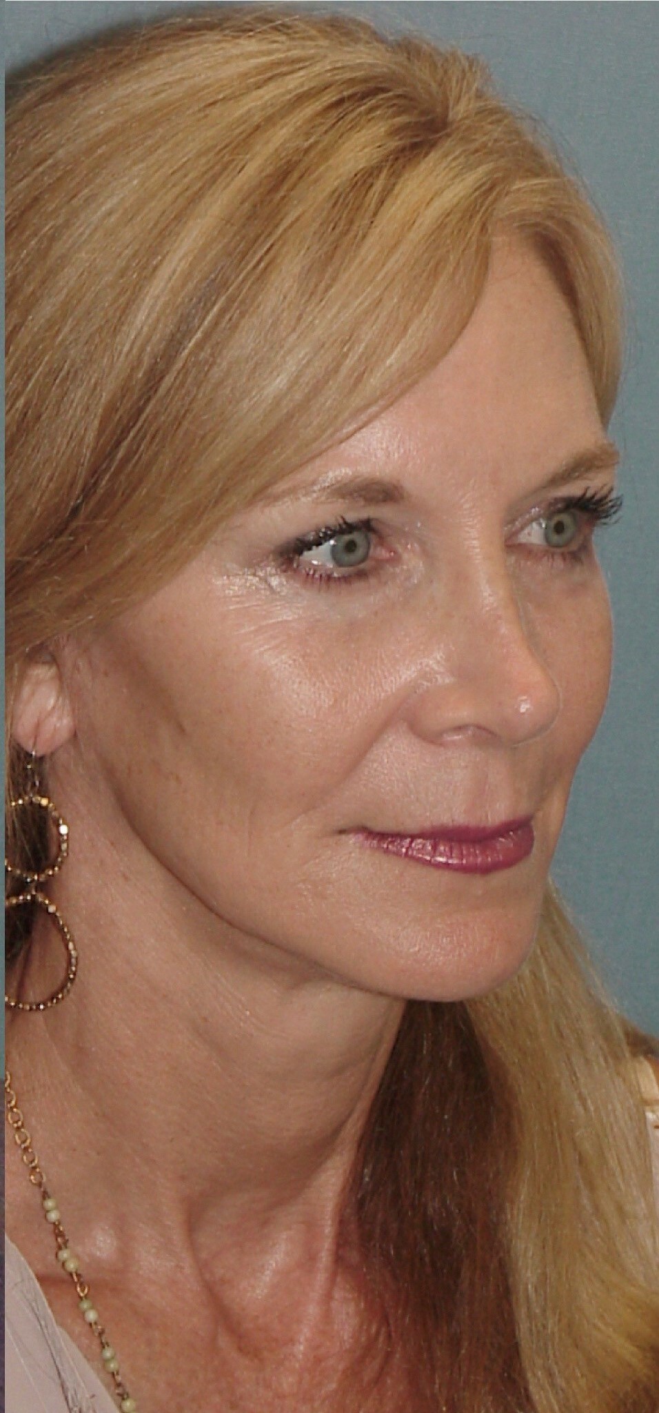 Photo of the patient’s after the Facelift Patient 1