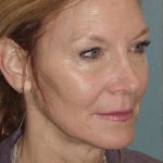 Thumbnail photo of the patient’s before the Facelift Patient 1