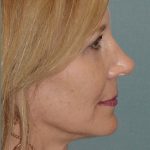 Thumbnail photo of the patient’s after the Facelift Patient 1