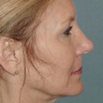 Thumbnail photo of the patient’s before the Facelift Patient 1