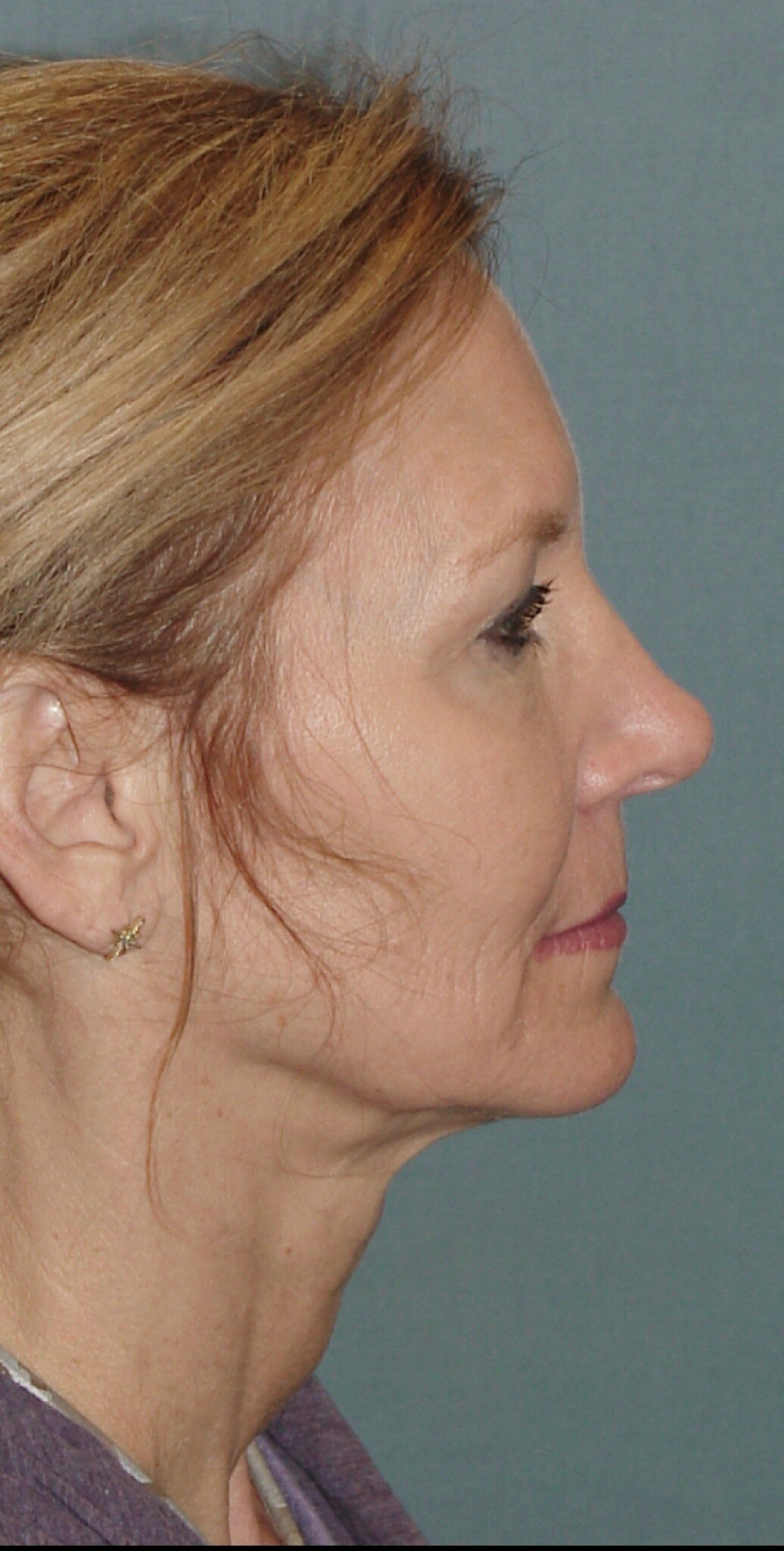 Photo of the patient’s before the Facelift Patient 1