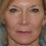 Thumbnail photo of the patient’s before the Facelift Patient 1