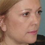 Thumbnail photo of the patient’s after the Facelift Patient 2