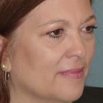 Thumbnail photo of the patient’s before the Facelift Patient 2