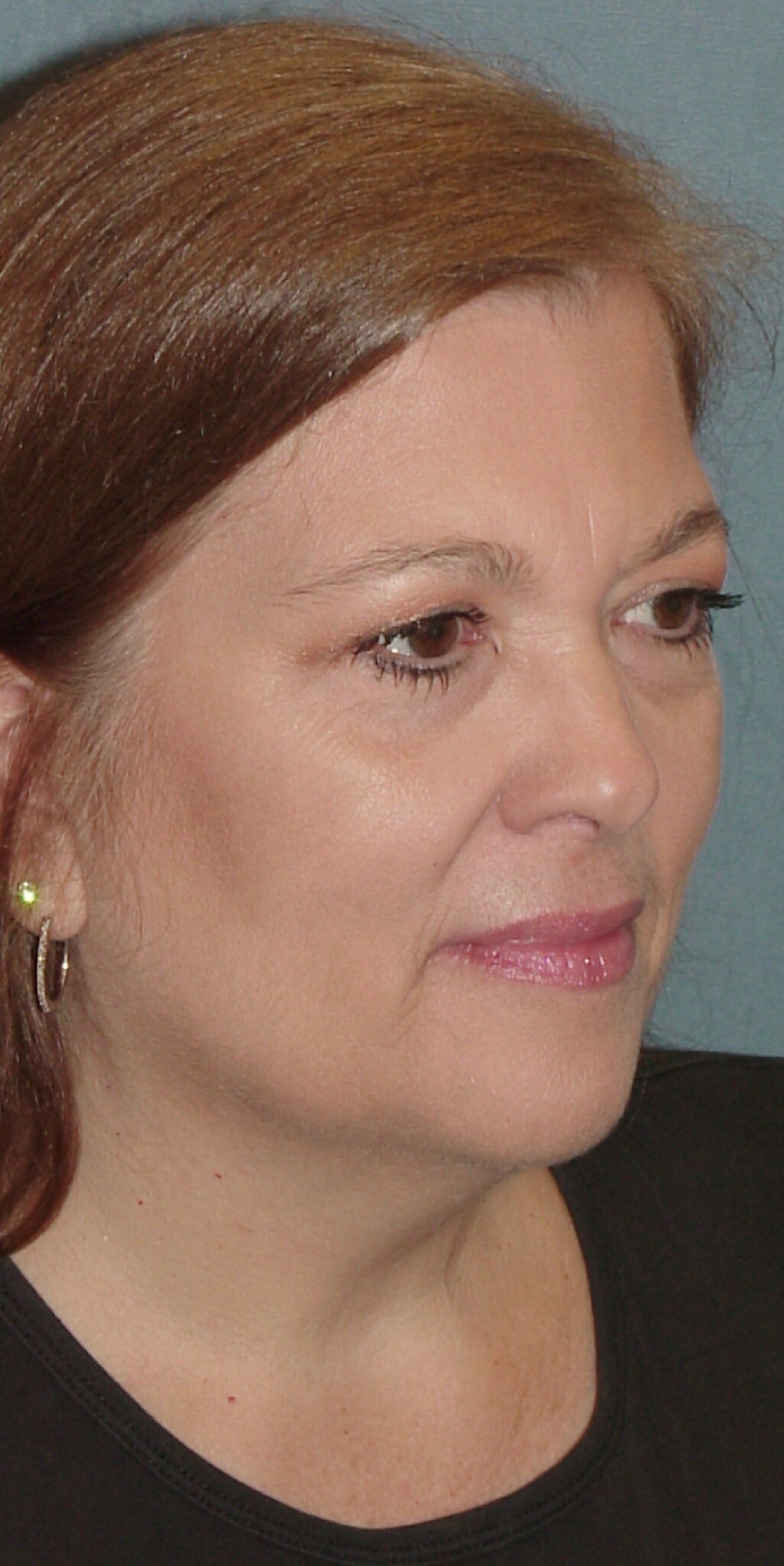 Photo of the patient’s before the Facelift Patient 2