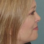 Thumbnail photo of the patient’s after the Facelift Patient 2