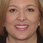 Thumbnail photo of the patient’s after the Facelift Patient 2