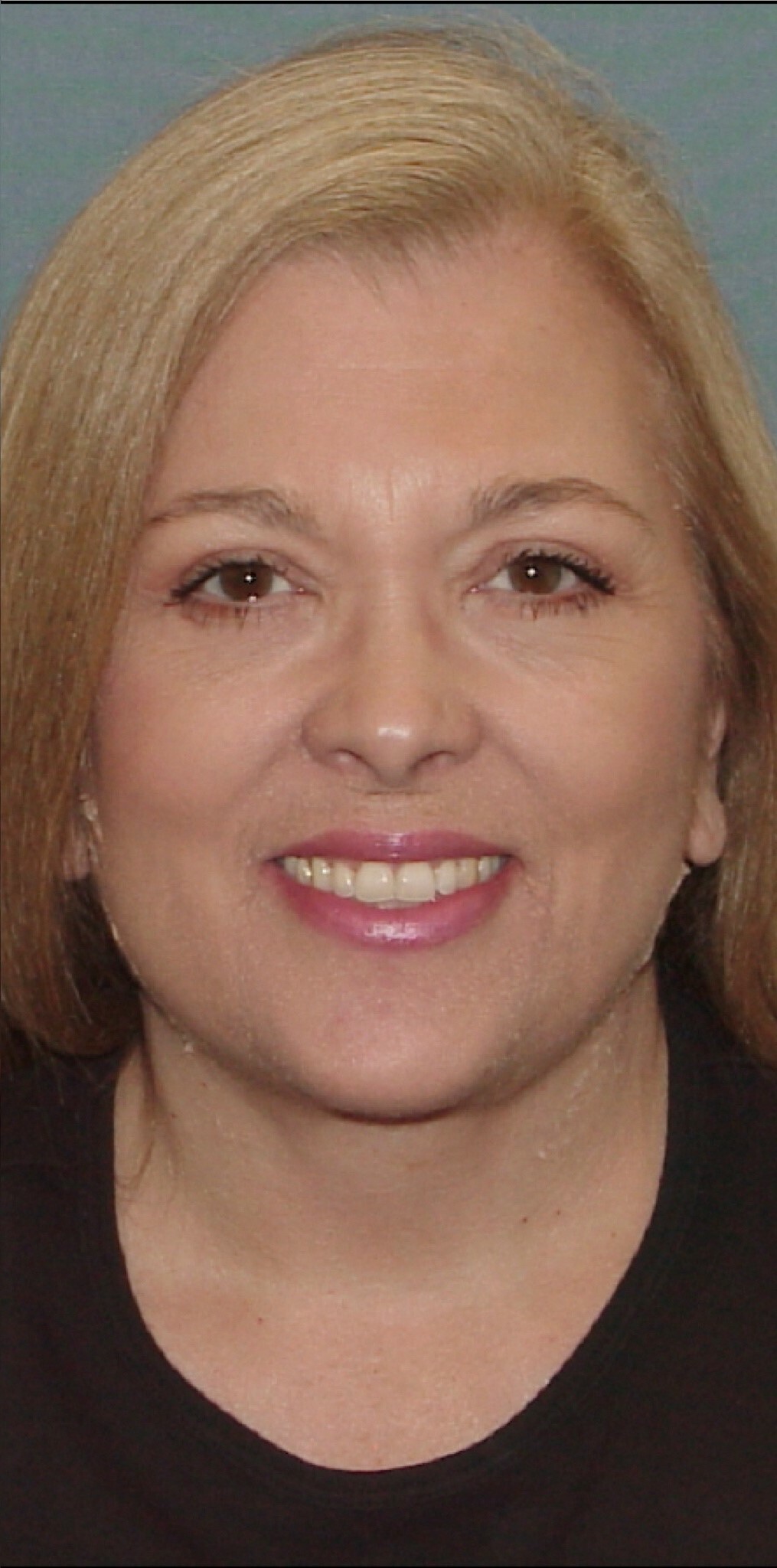 Photo of the patient’s after the Facelift Patient 2